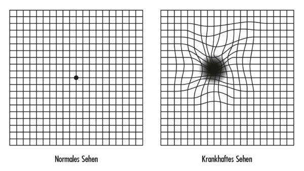 Altersbedingte_Makuladegeneration_AMD_Amsler_Test-600x338