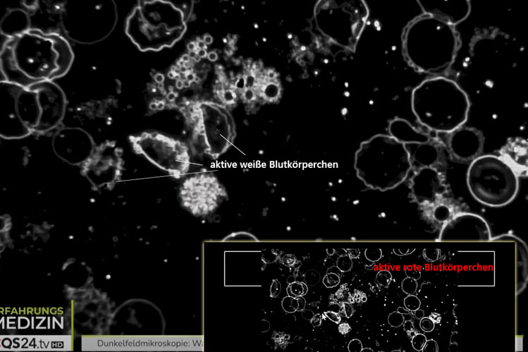 Dunkelfeldmikroskopie-weisse-Blutkoerperchen-Geldrollenbildung-geloest