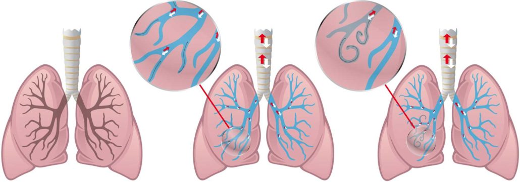 COPD Lunge coils